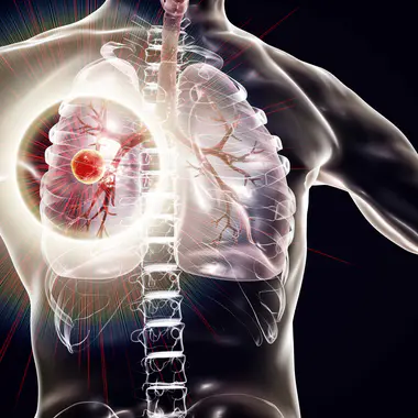 La tuberculose pulmonaire